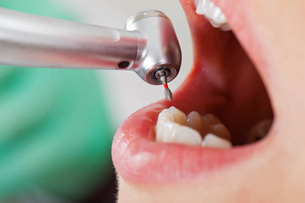 Best Emergency Root Canal Treatment in Frazee, MN